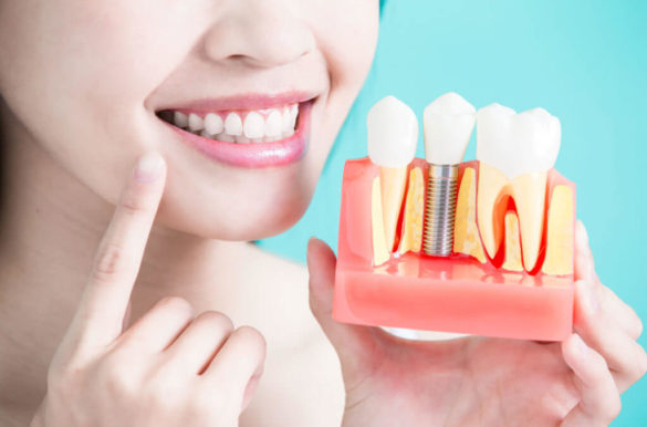 dental implant silver spring md