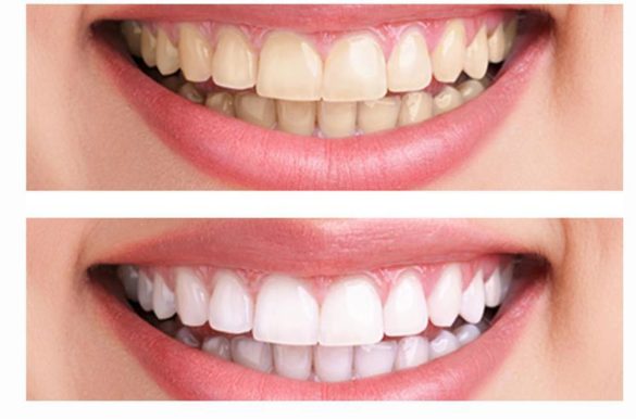 teeth whitening