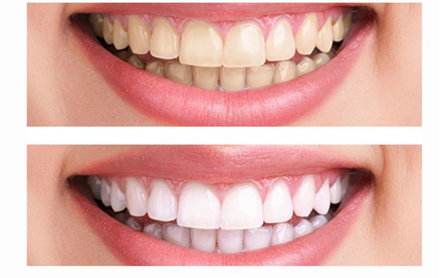 Teeth Whitening | Silver Spring MD | Cosmetic Dentistry | Takoma Park