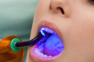 filling cavities