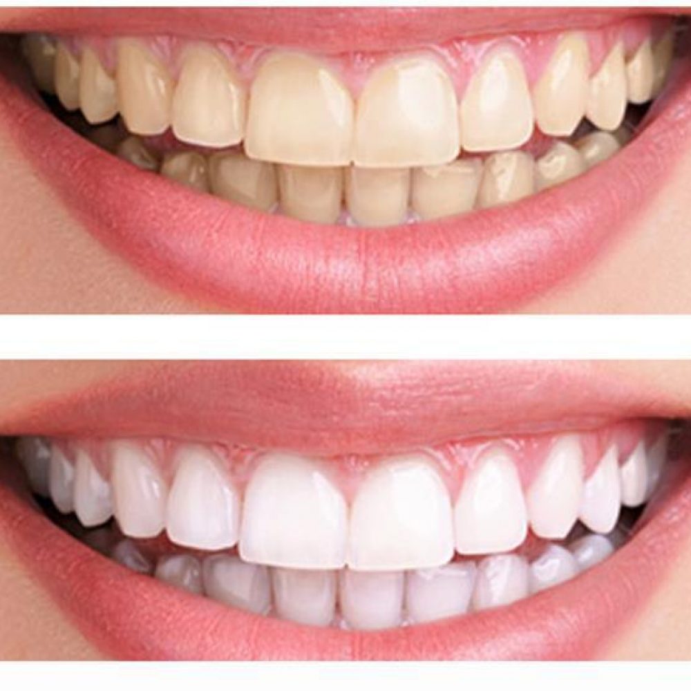 teeth whitening teeth whitening